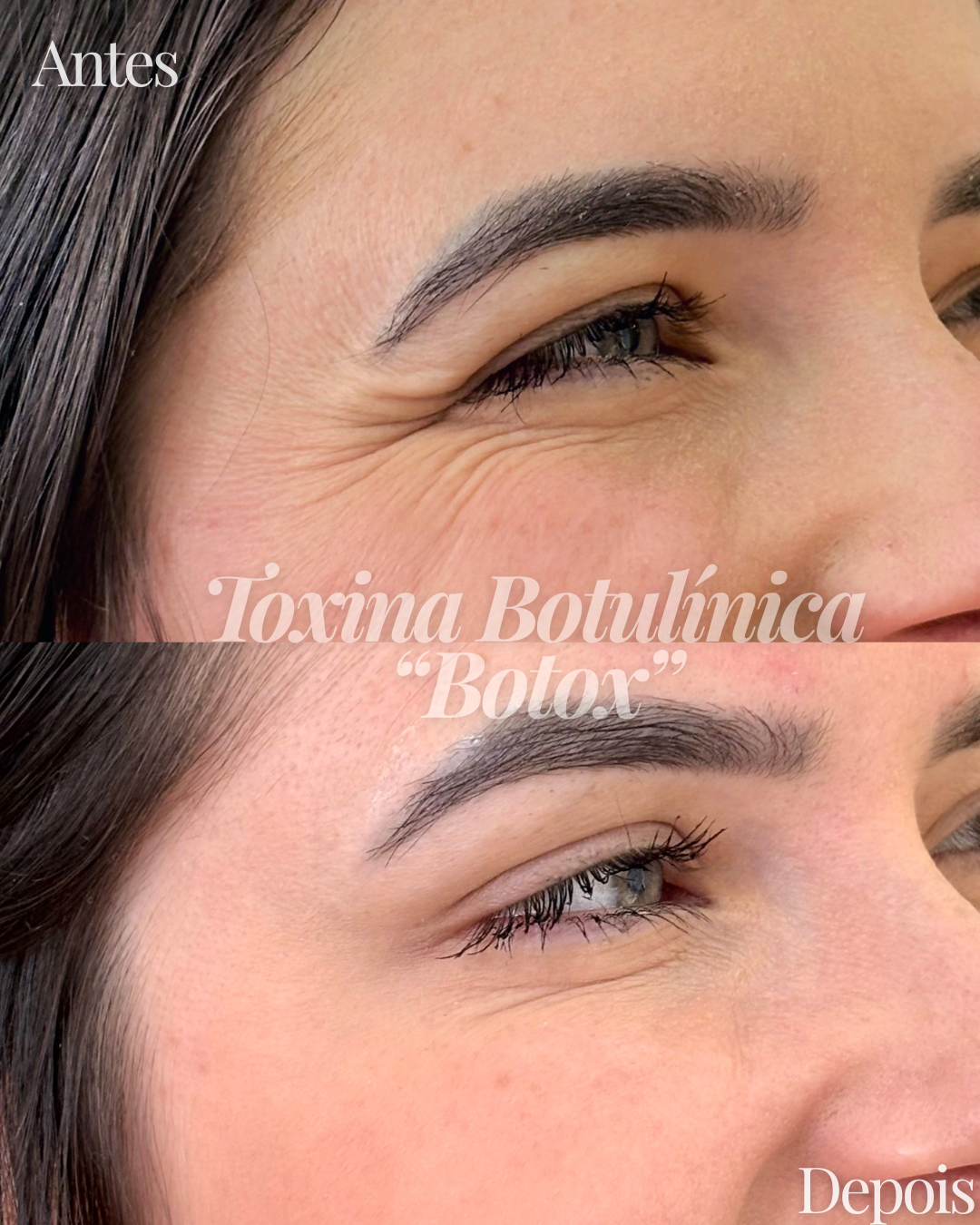 Antes e depois — toxina botulínica (Botox)