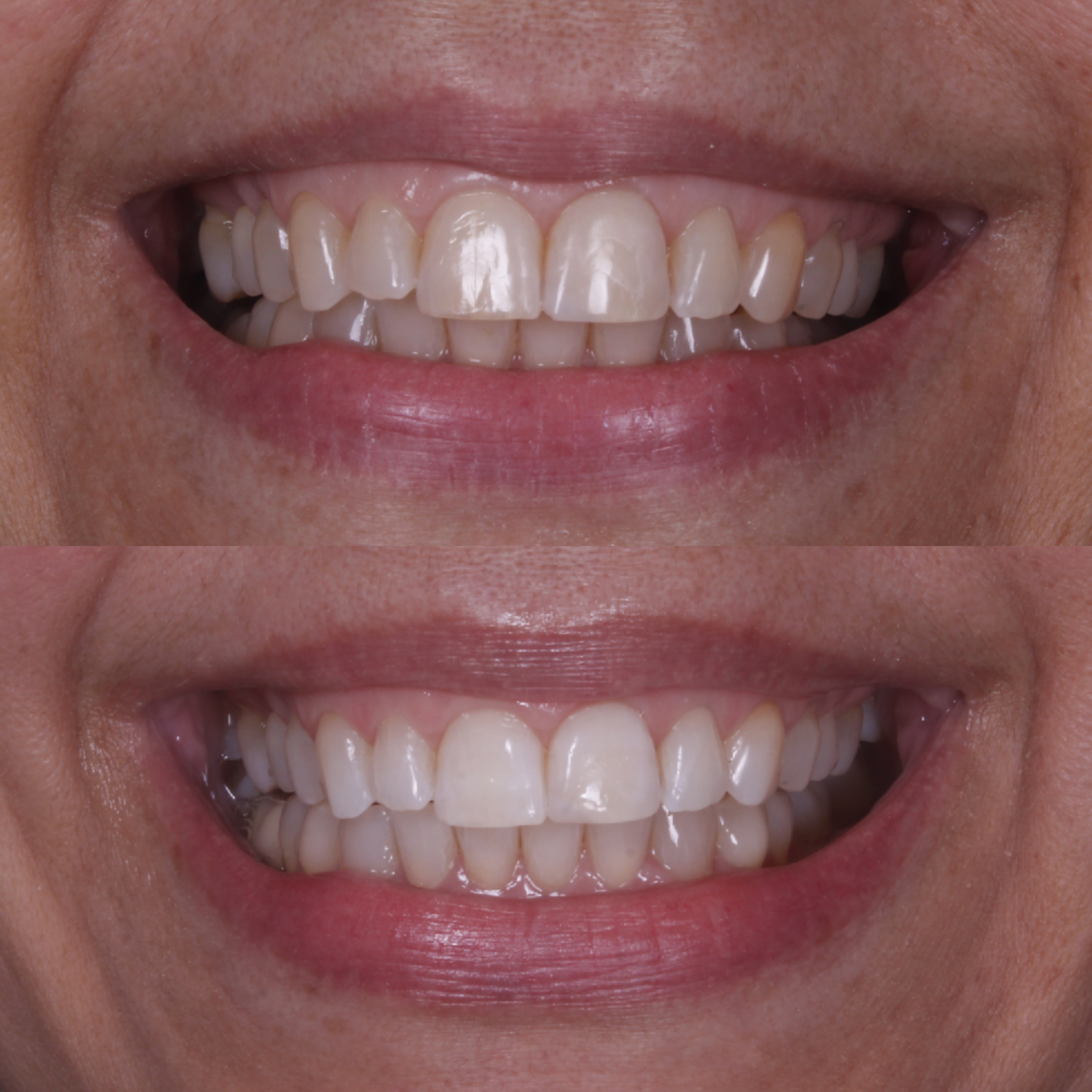 Antes e depois — clareamento dental