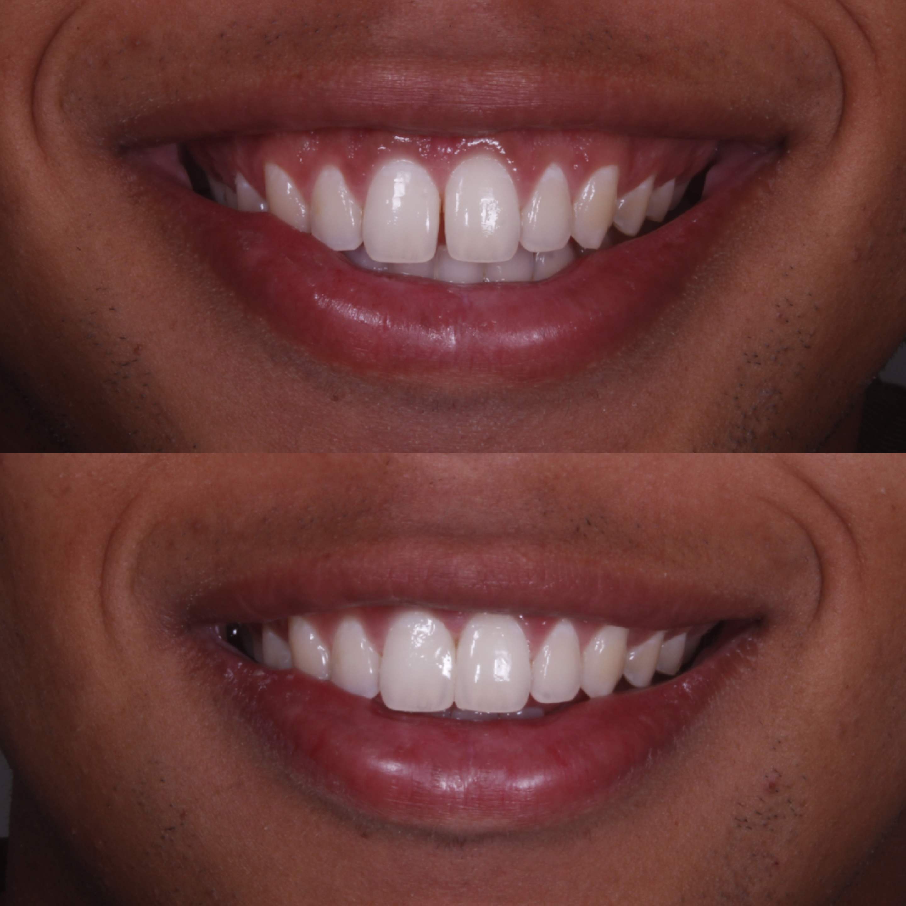 Antes e depois — fechamento de diastema