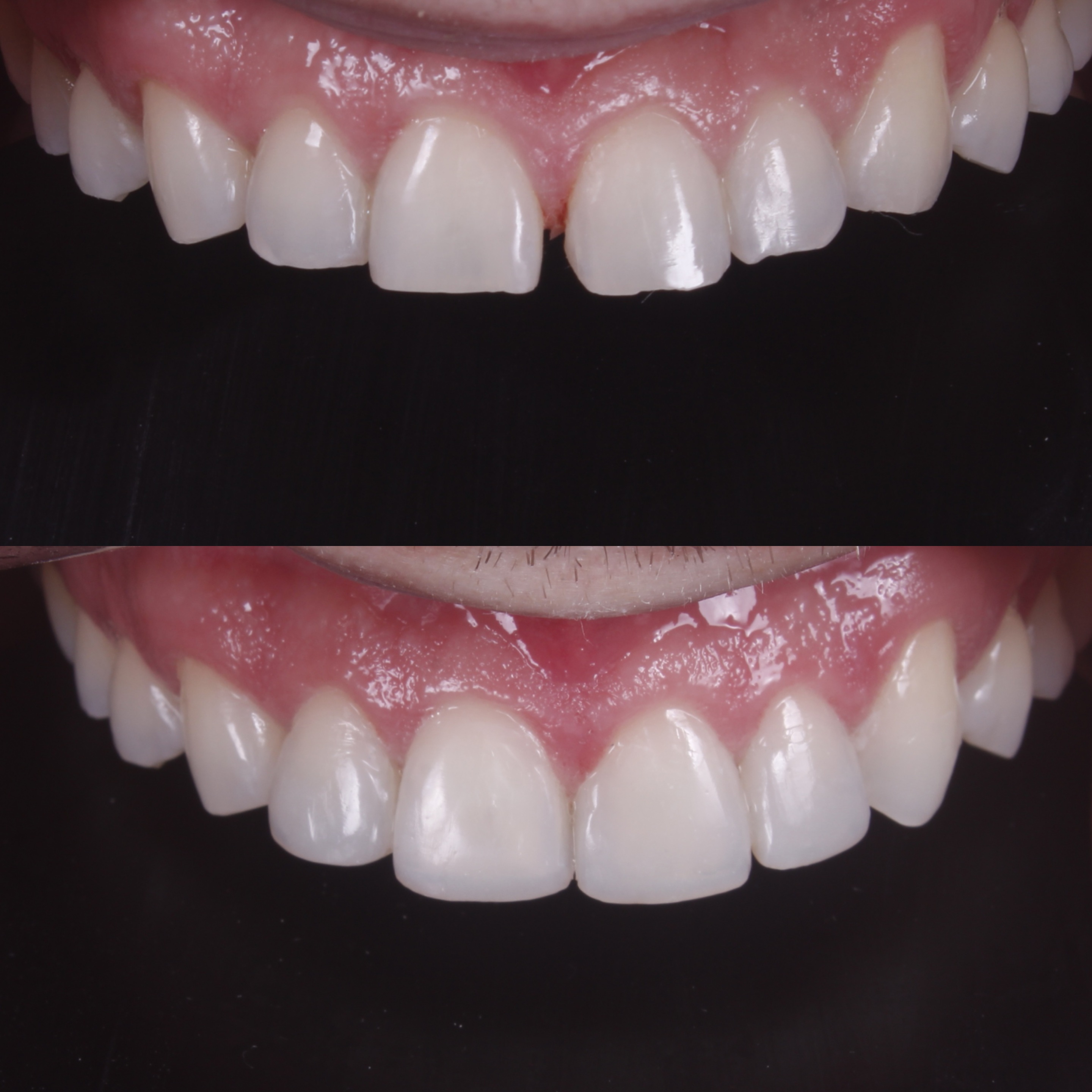 Antes e depois — facetas