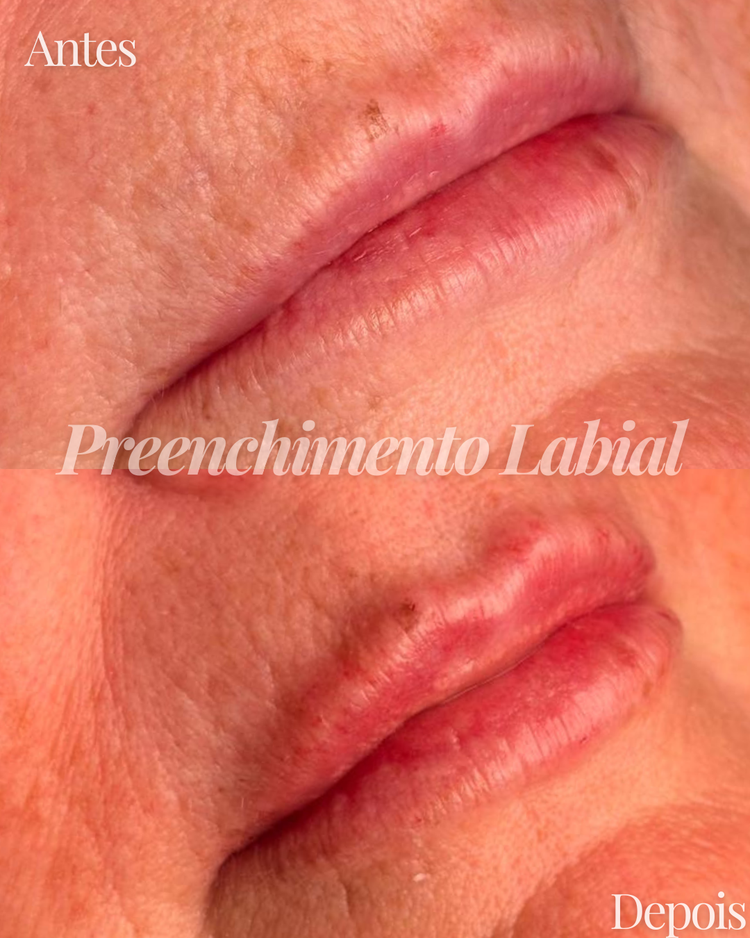 Antes e depois — preenchimento labial