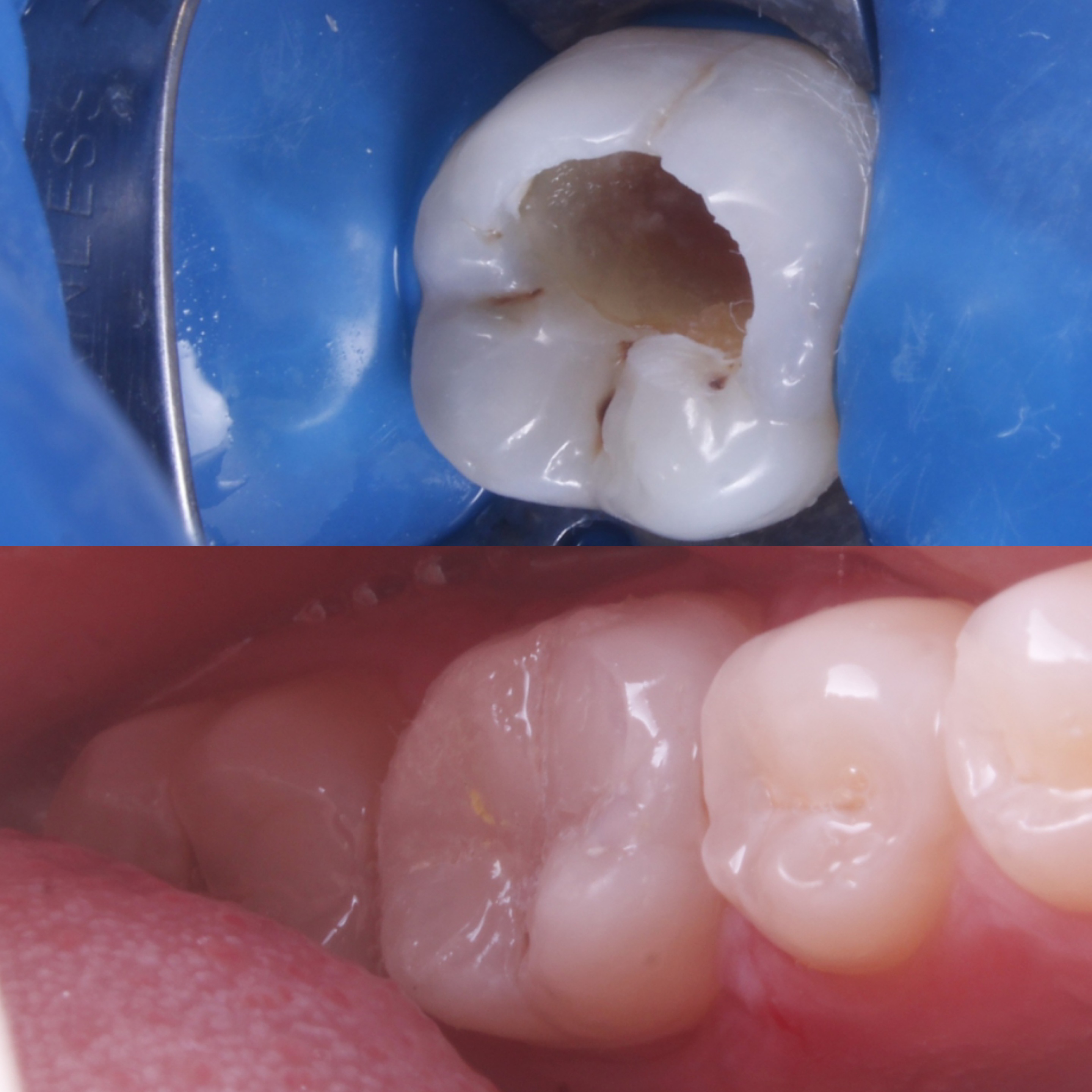 Antes e depois — restauração direta