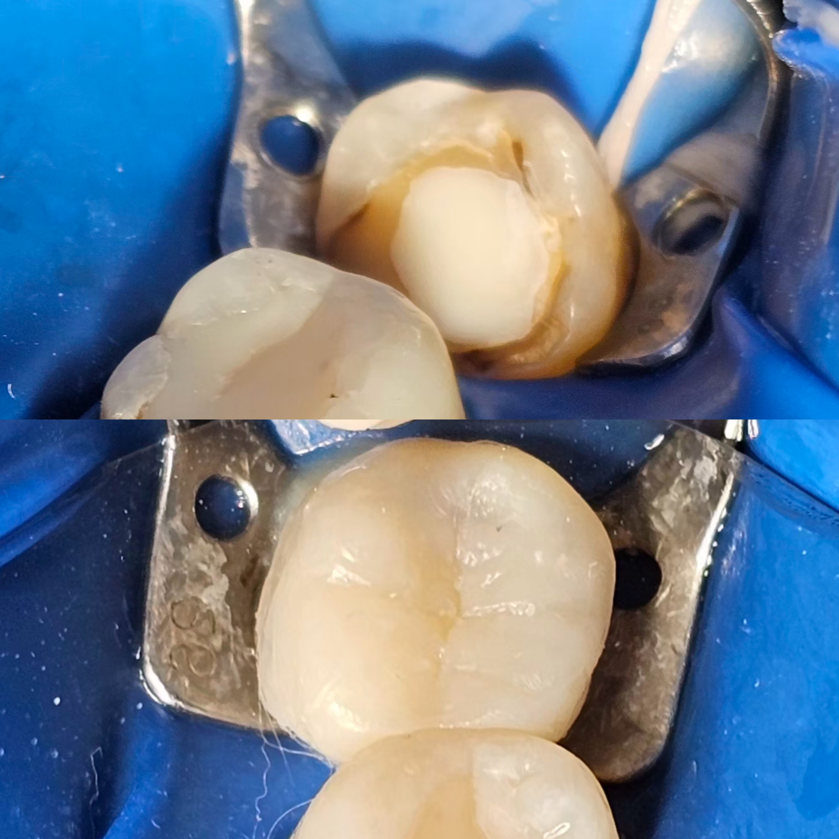 Antes e depois — restauração indireta